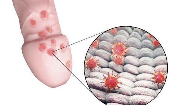 Allergia al gel per l'ingrandimento del pene