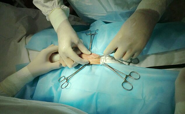 La chirurgia sull’organo riproduttivo può aiutare ad aumentarne le dimensioni